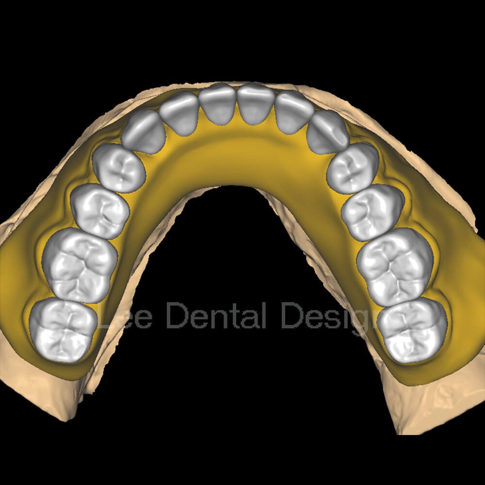 Acrylic denture base design checked for border extension and palatal seal before release