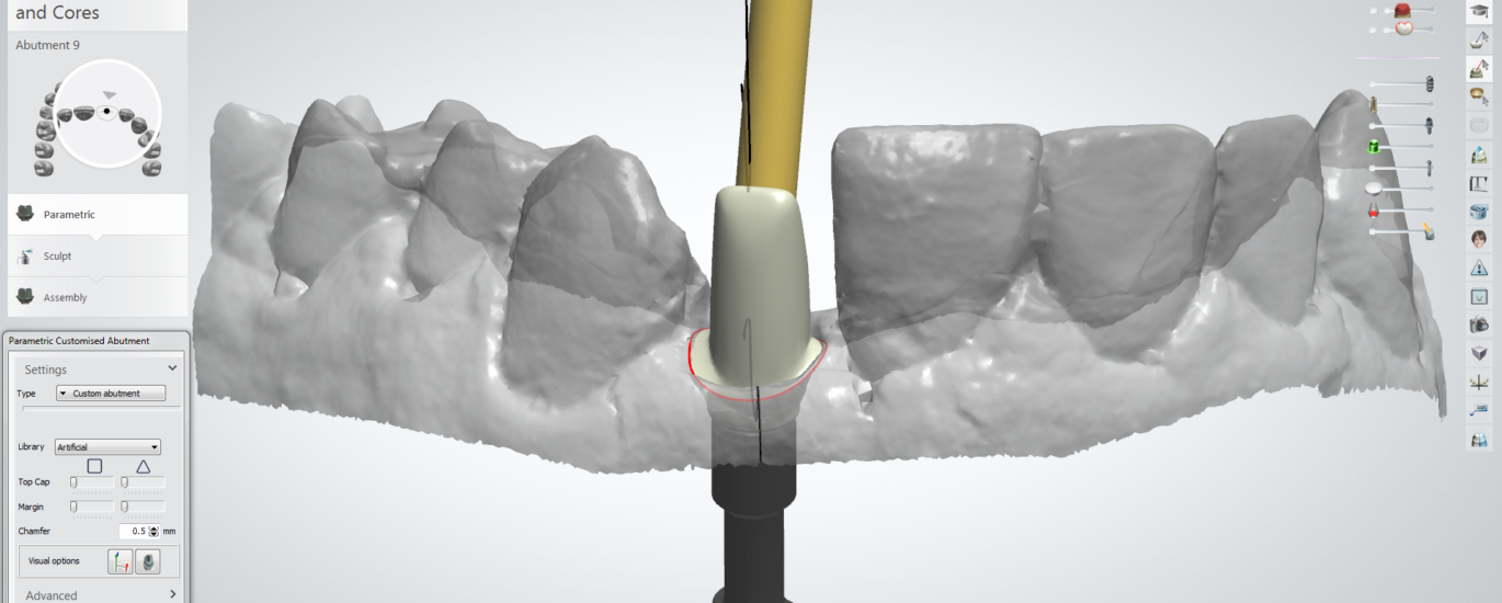 exocad design workflow screen: abutment and post and core step