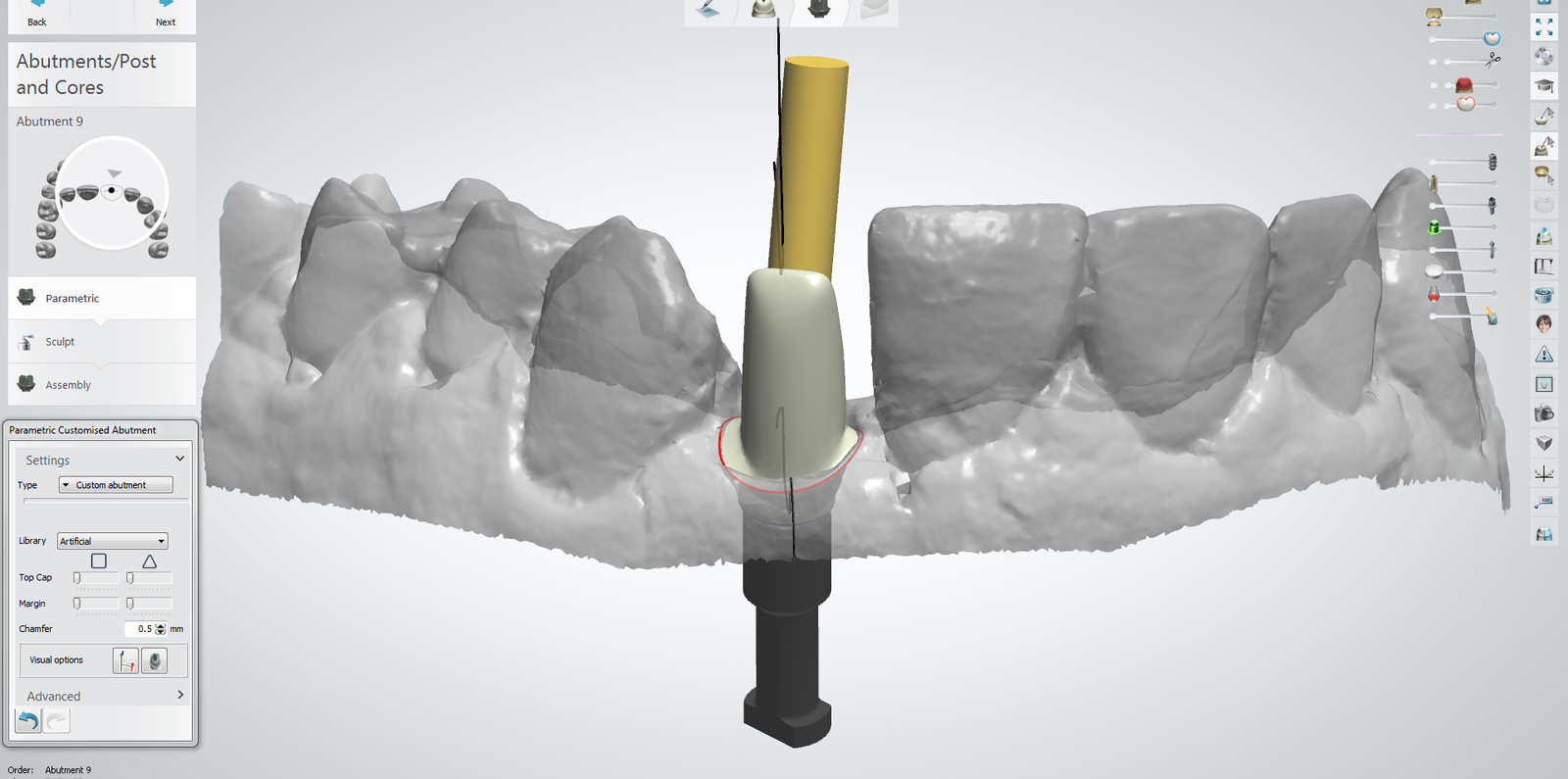 exocad design workflow screen: abutment and post and core step